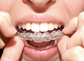 Reposición de Brackets autoligables estéticos en la Dental Care Sarrià