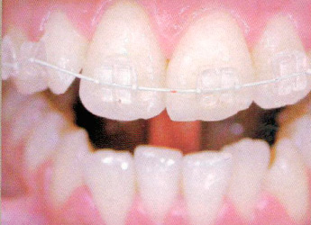 Ortodoncia con brackets estéticos cerámicos (dos arcadas) en Dental Care Sarriá