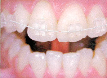 Ortodoncia con Brackets Estéticos de Porcelana en Clínica Dental Zendrera Hospitalet