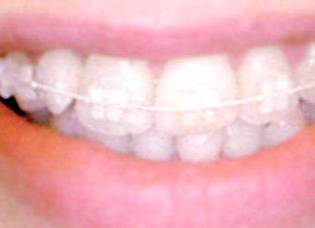 Ortodoncia fija con Brackets de Zafiro en Clínica Dental Habana 77