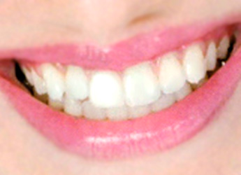 TAC Dental en Ávila de maxilar inferior + maxilar superior