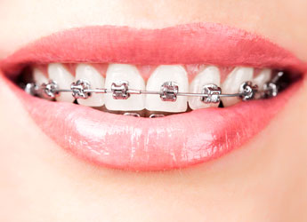 Tratamiento de ortodoncia con brackets metálicos (una arcada) en Dental Care Sarria en Barcelona