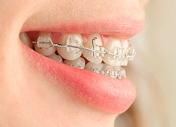 Tratamiento de ortodoncia con brackets metálicos (dos arcadas) en Dental Care Sarriá