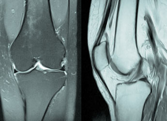 Resonancia de Rodilla en Sant Cugat del Vallés